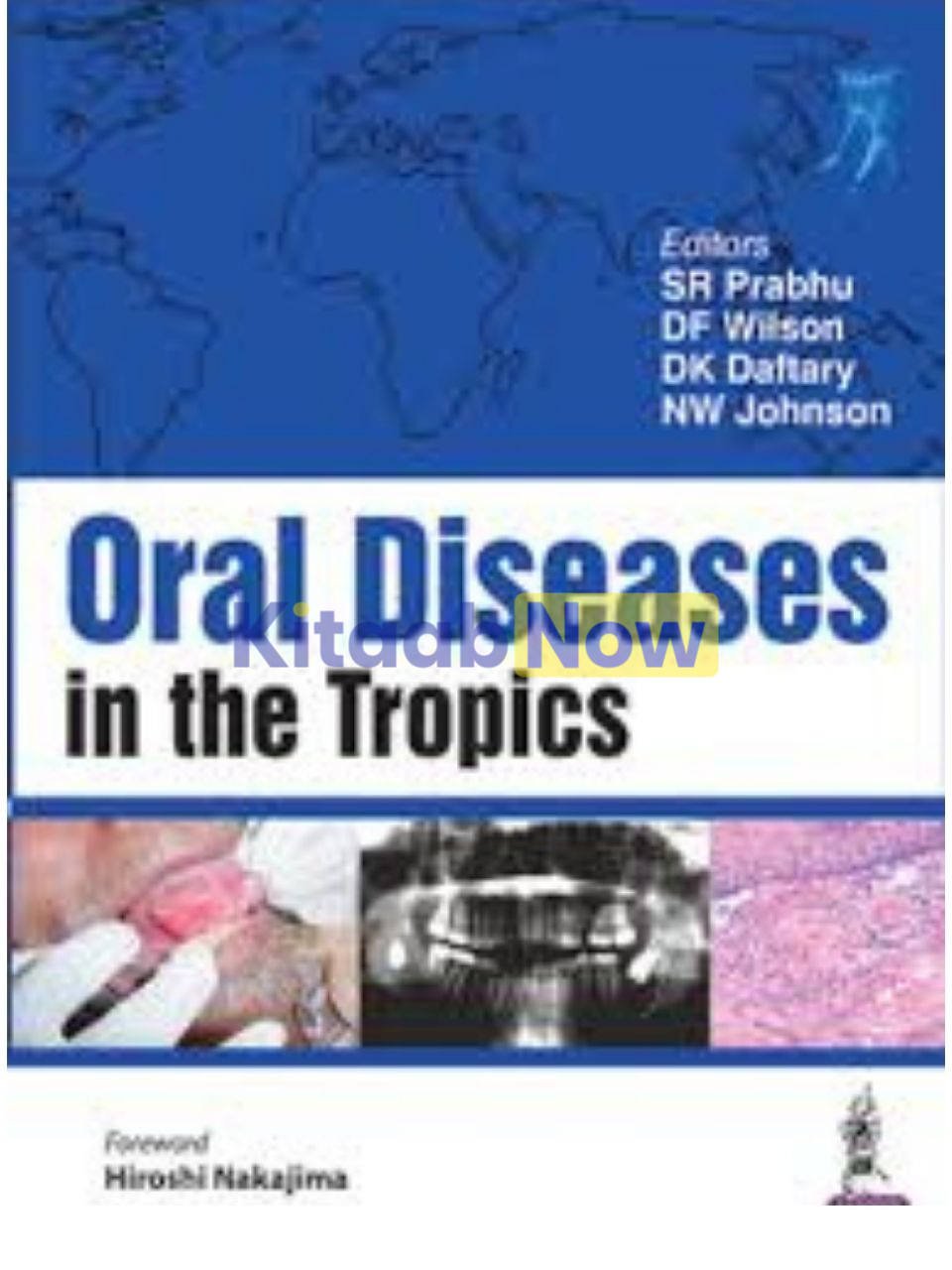 Oral Diseases In The Tropics